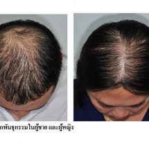 โรคผมร่วงแบบไหนที่ควรมาพบแพทย์