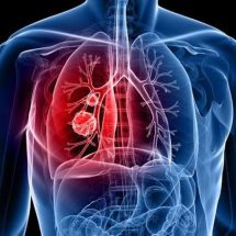 ไม่สูบบุหรี่ก็สามารถเป็นมะเร็งปอดได้